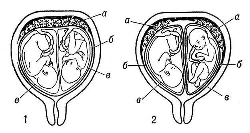 Двойня: 1 — однояйцевая; 2—двуяйцевая