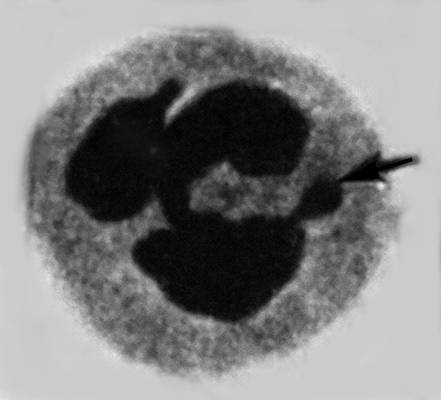 Нейтрофильный лейкоцит с «барабанной палочкой»