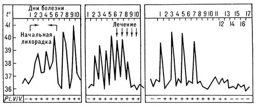 Температурная кривая при трёхдневной малярии