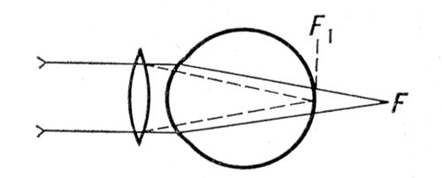 Ход лучей в глазу при дальнозоркости