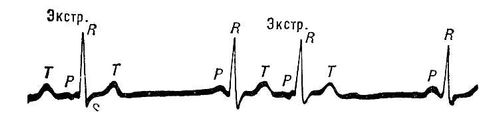 Экстрасистолия